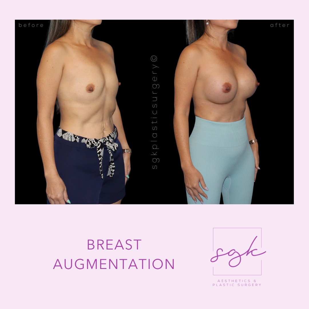 Breast Augmentation Before and After