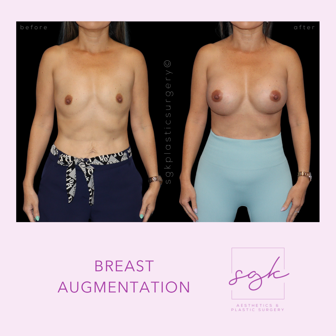 Breast Augmentation Before and After
