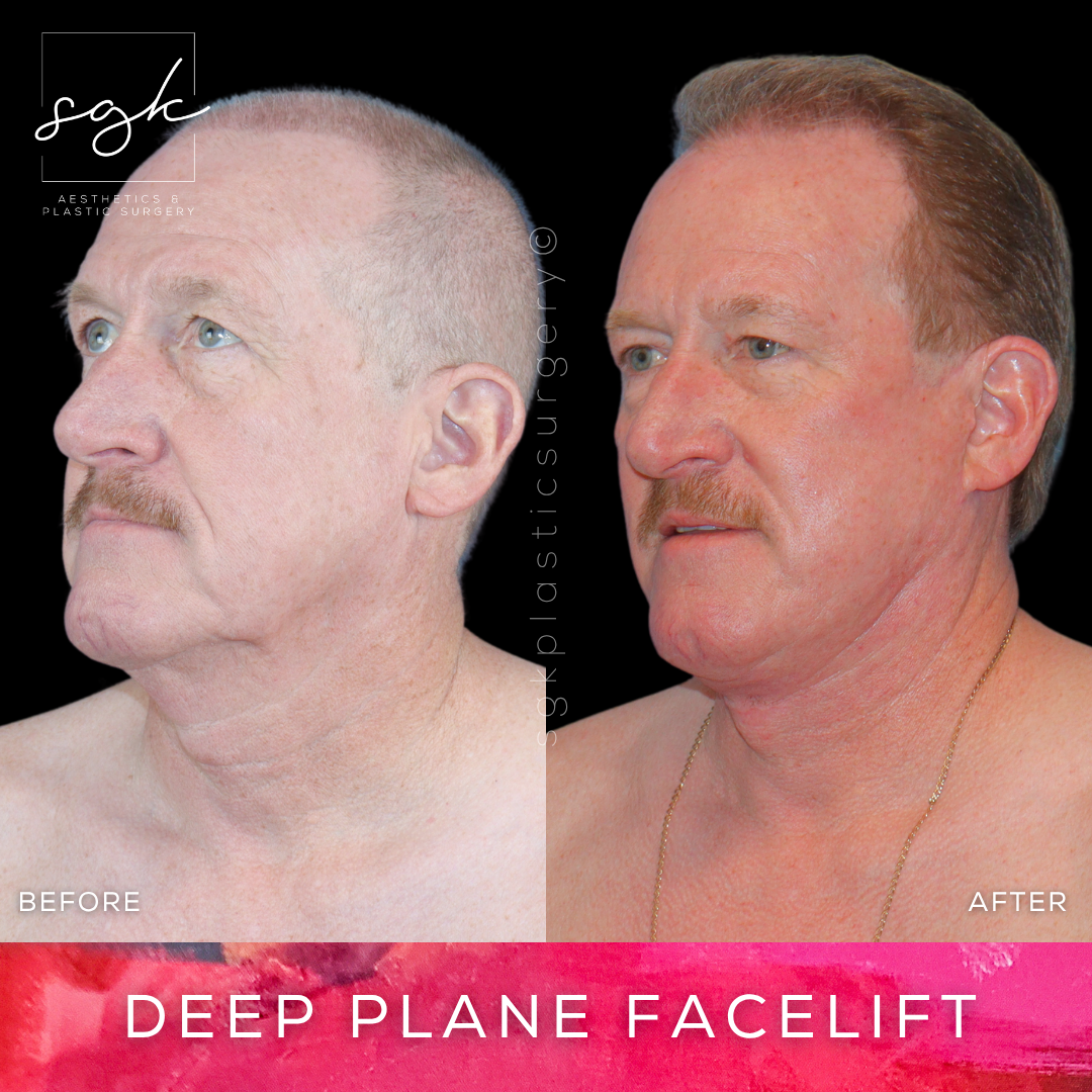 Deep Plane Facelift Before and After