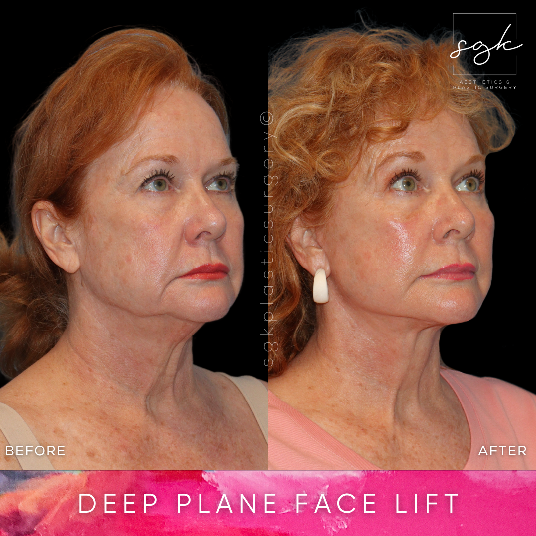 Deep Plane Facelift Before and After