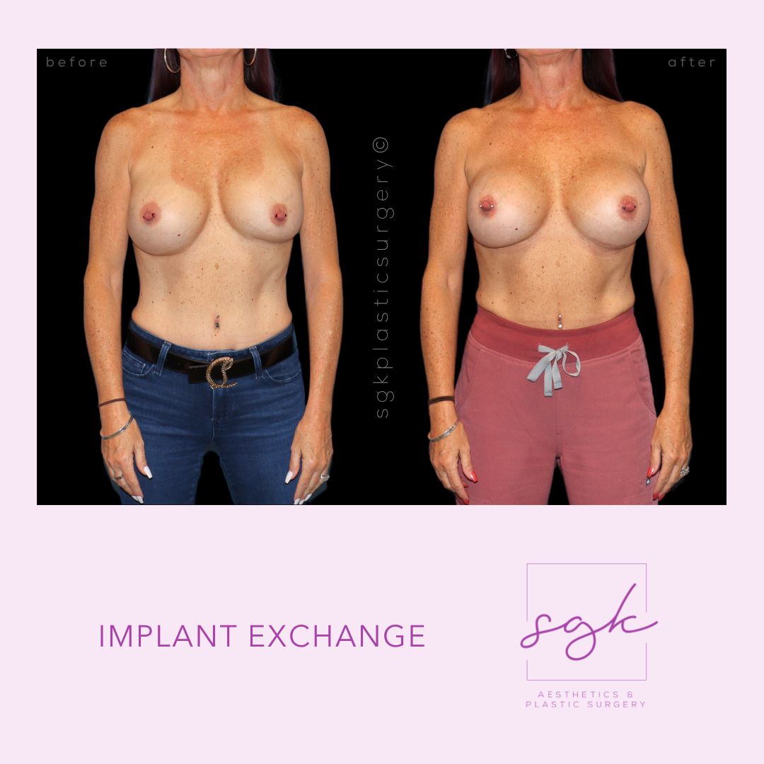Implant Exchange Before and After