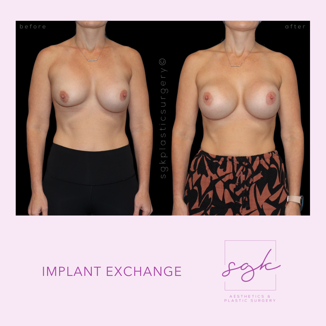 Implant Exchange Before and After