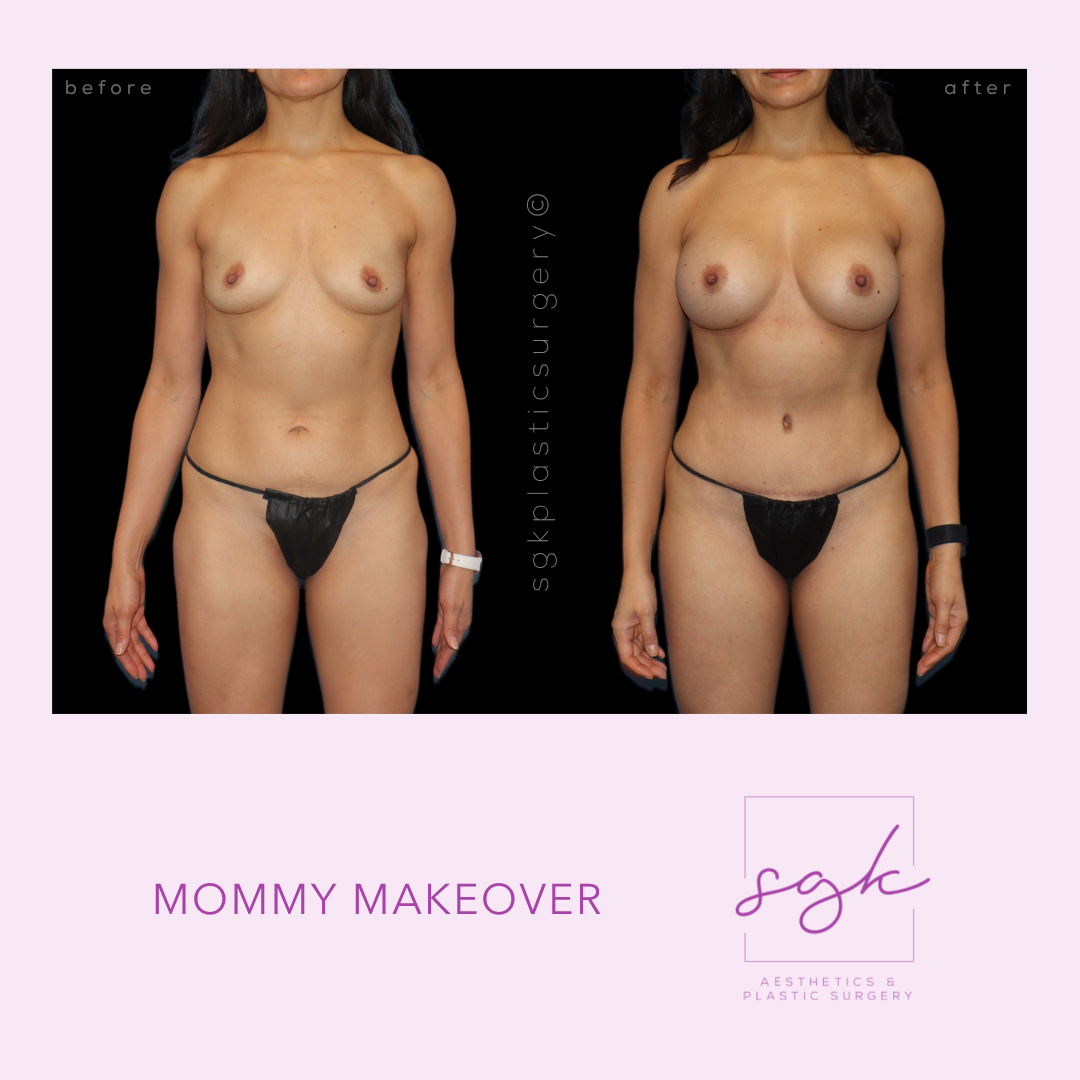 Mommy Makeover Before and After