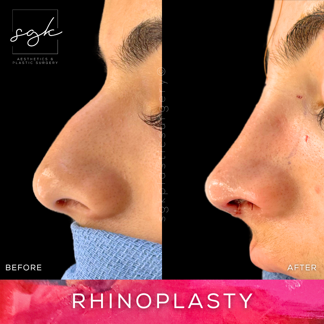Rhinoplasty Before and After
