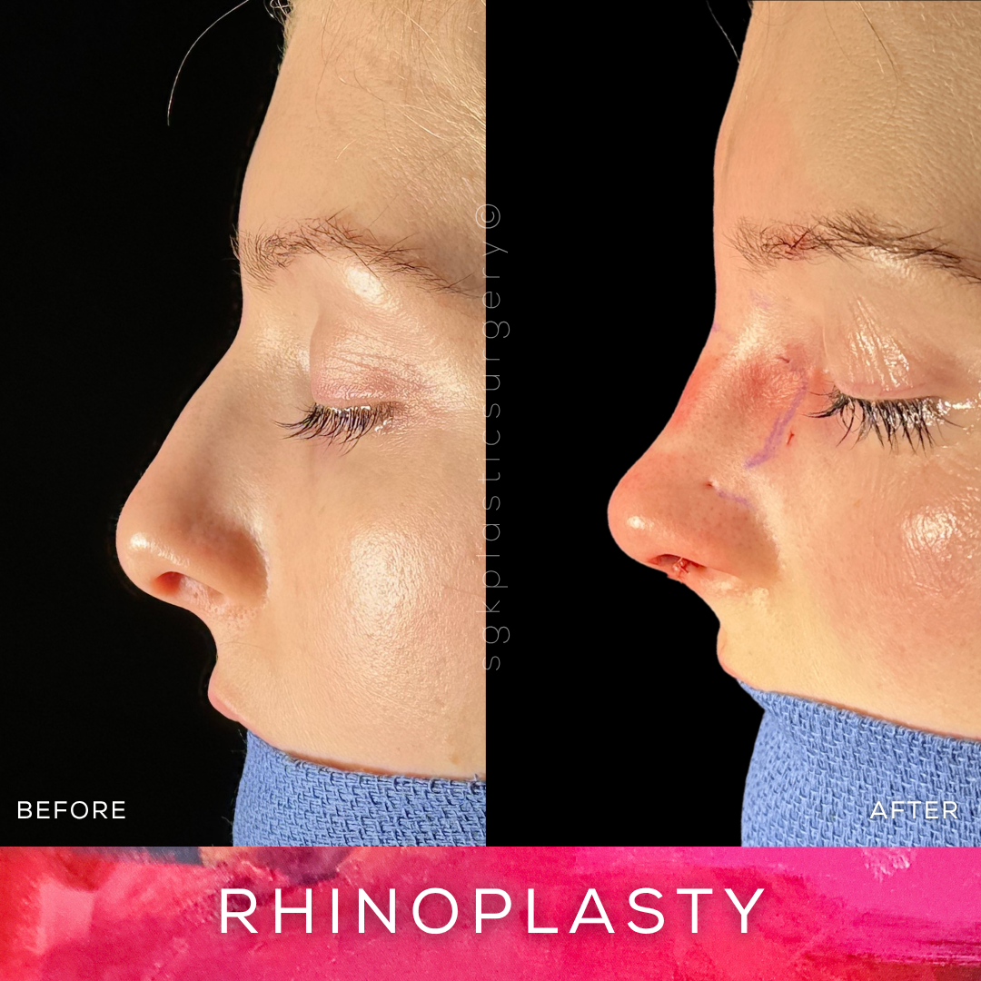 Rhinoplasty Before and After