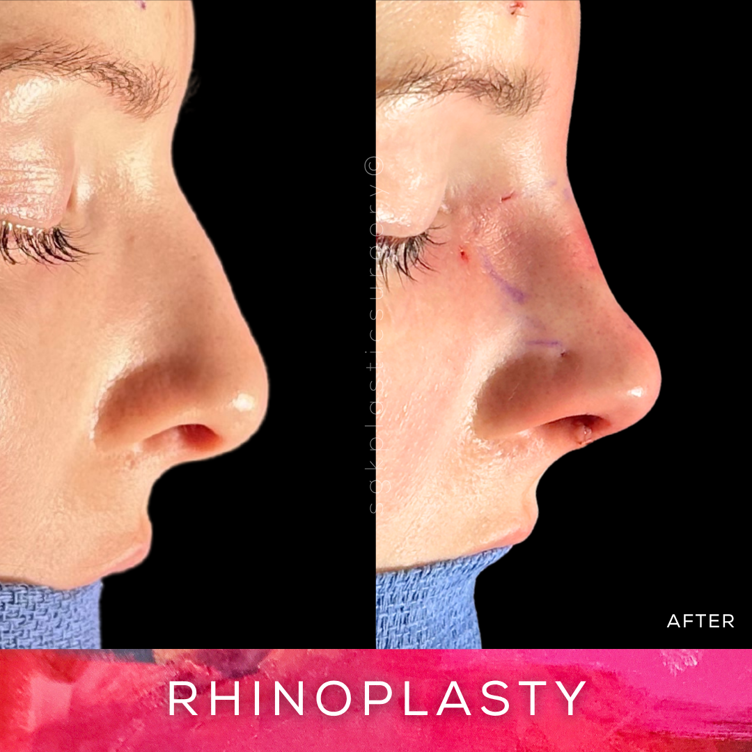 Rhinoplasty Before and After