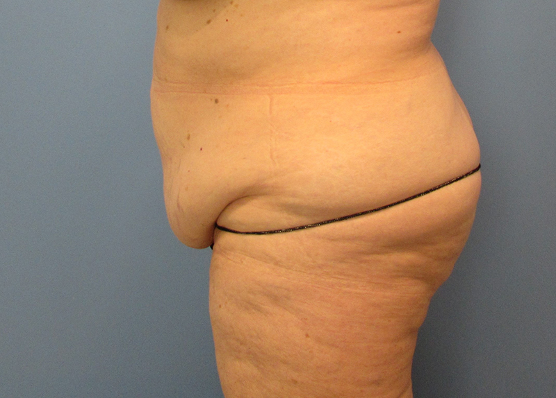 Tummy Tuck Before and After | SGK Plastic Surgery