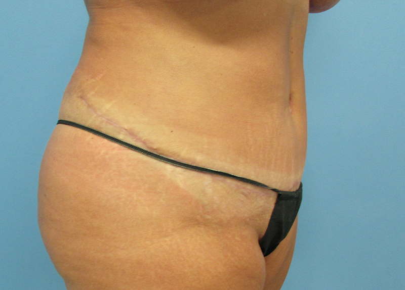 Tummy Tuck Before and After | SGK Plastic Surgery