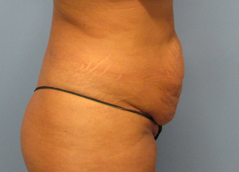 Tummy Tuck Before and After | SGK Plastic Surgery