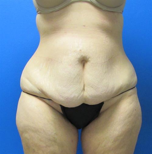 Tummy Tuck The Woodlands and Conroe