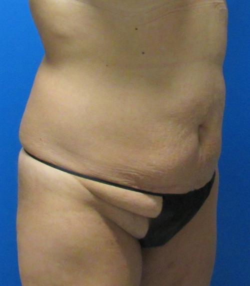 Tummy Tuck Before and After | SGK Plastic Surgery