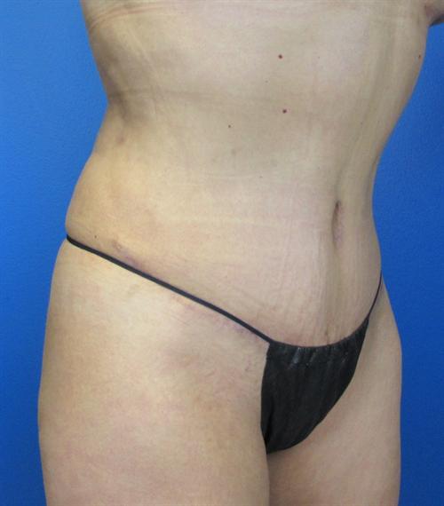 Tummy Tuck Before and After | SGK Plastic Surgery