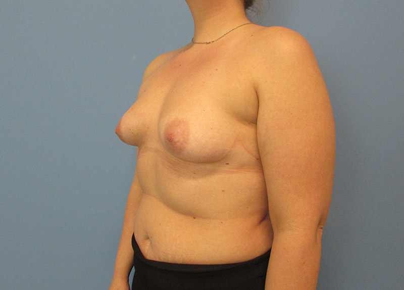 Breast Augmentation Before and After | SGK Plastic Surgery