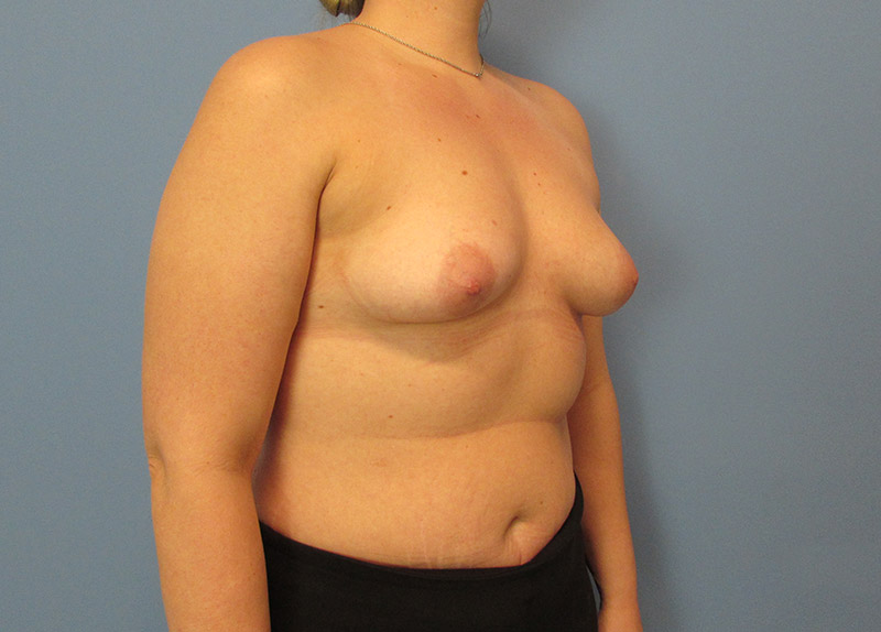 Breast Augmentation Before and After | SGK Plastic Surgery