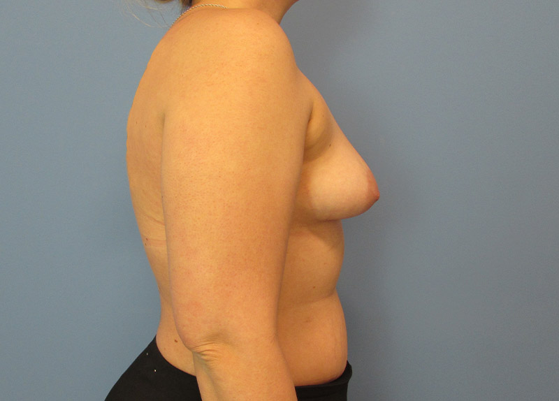 Breast Augmentation Before and After | SGK Plastic Surgery