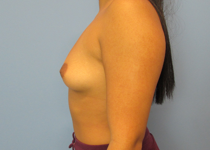 Breast Augmentation Before and After | SGK Plastic Surgery