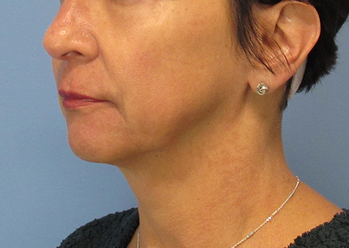 Facelift Before and After | SGK Plastic Surgery